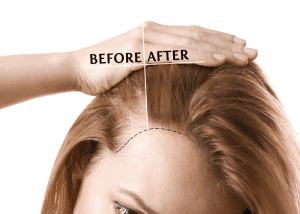 HairMD anti-hair-loss-before-after png 1