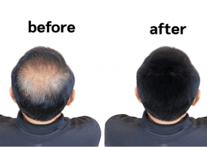 HairMD anti-hair-loss-before-after png 3